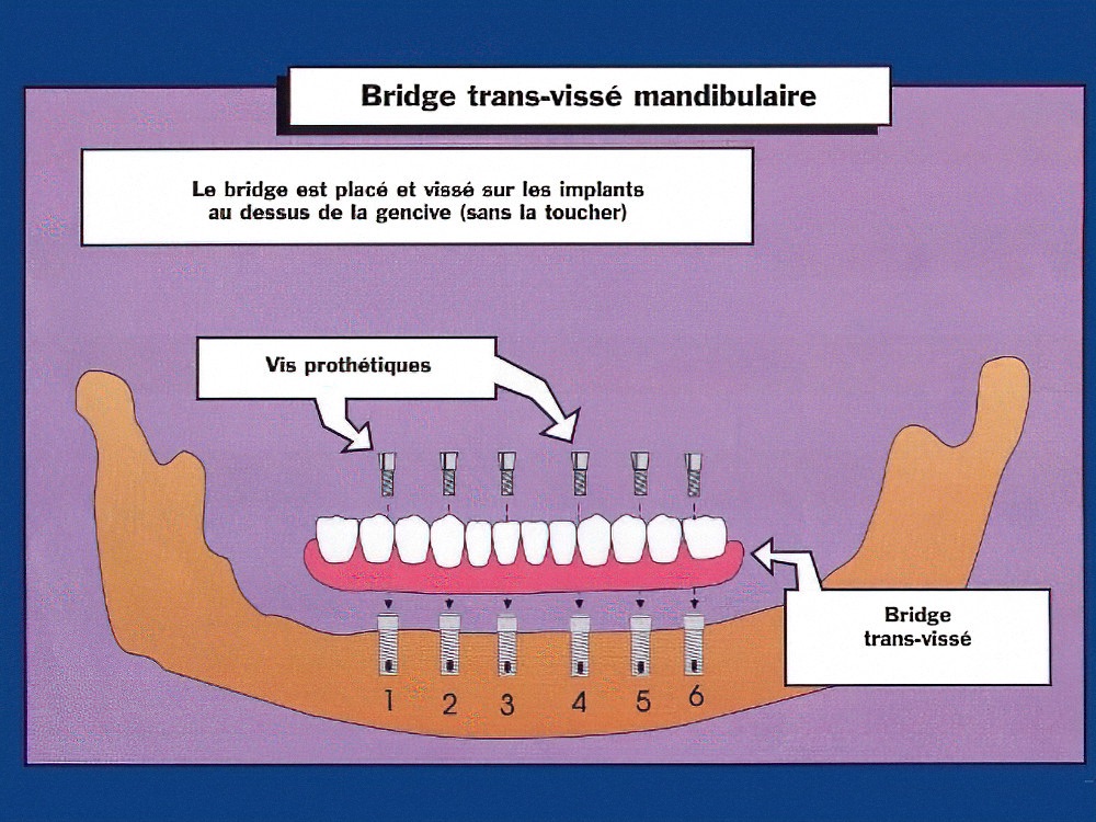 Bridge transvissé sur implants mandibulaire Strasbourg